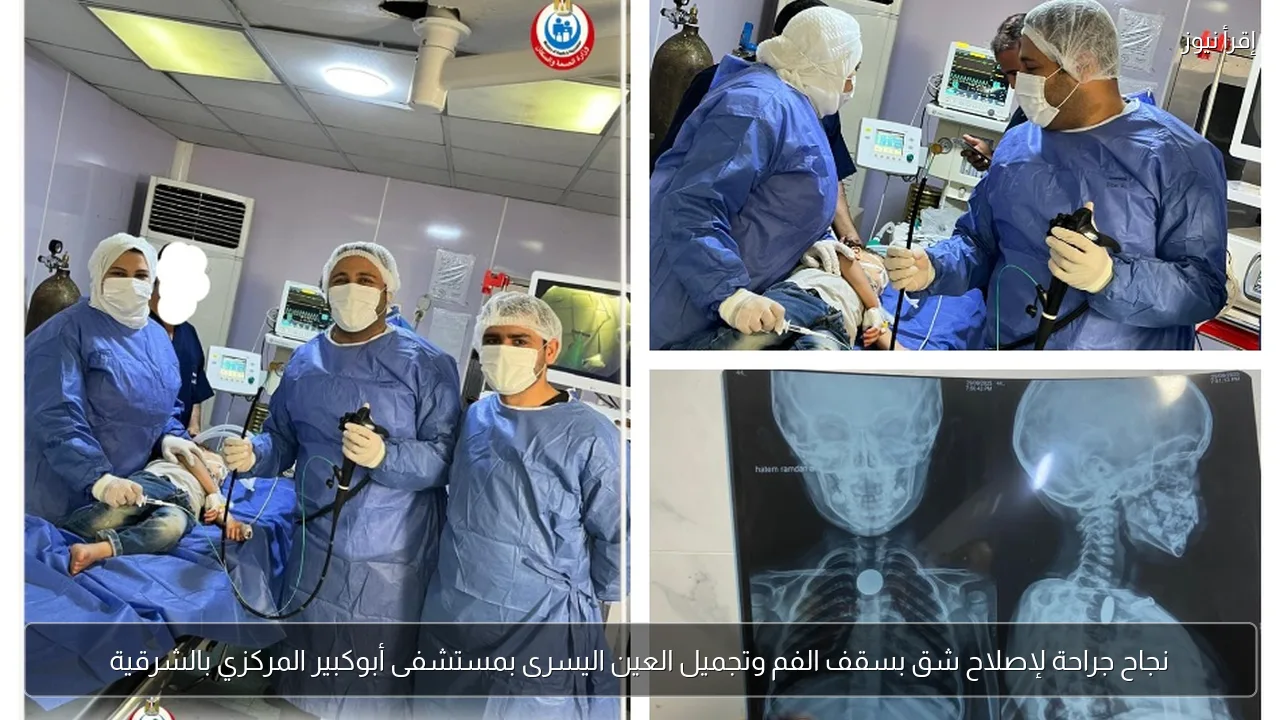نجاح جراحة لإصلاح شق بسقف الفم وتجميل العين اليسرى بمستشفى أبوكبير المركزي بالشرقية