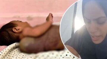 رضيعة في غزة تواجه أزمة صحية خطيرة بسبب كيس دموي
